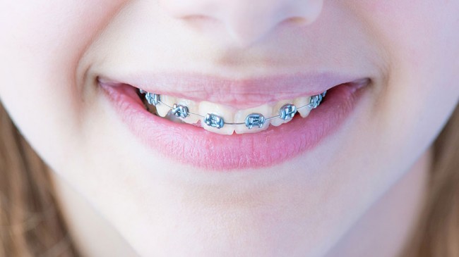 Diş Teli Tedavisi Nasıl Yapılır ?